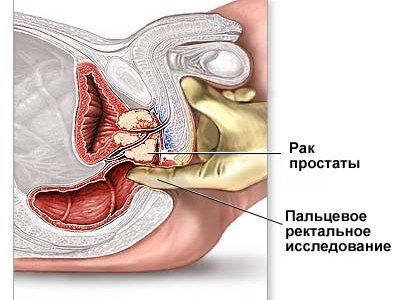 рак простаты