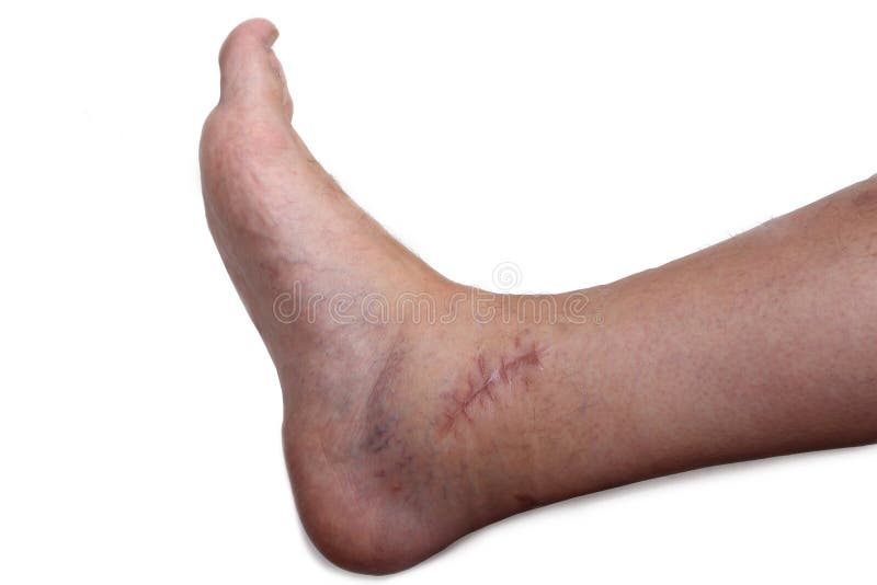 post-operative ankle royalty free stock photo