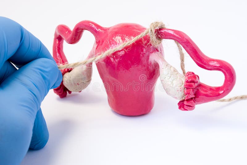 Tubal ligation or surgical procedure tubectomy in operative gynecology concept photo. Doctor binds with rope fallopian tubes model stock photo